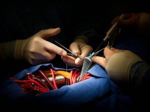 Cirugía a Corazón Abierto Dr. Benjo Gareca Villarpando Cirujano Cardiovascular Cochabamba