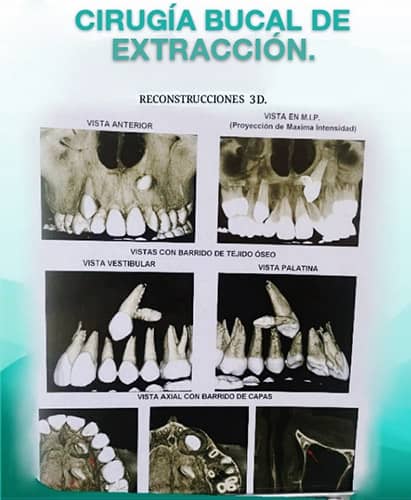 Cirugia bucal de Extracción - Cáncer Bucal - Centro de Cirugía y traumatología Bucomaxilofacial en cochabamba, La Paz