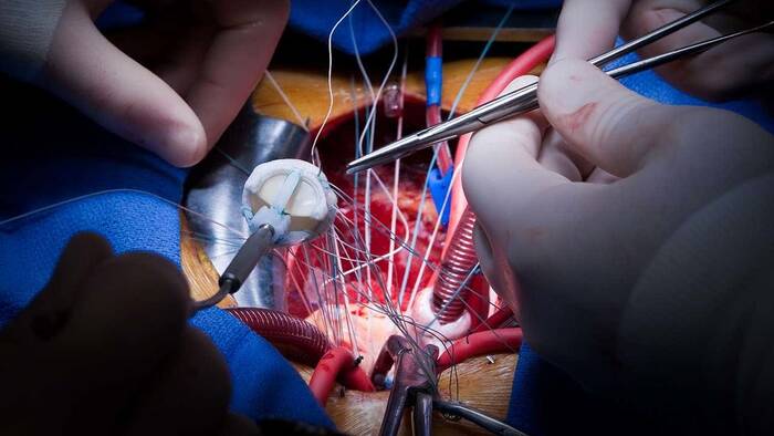 Heart Surgery Aortic Valve Replacement