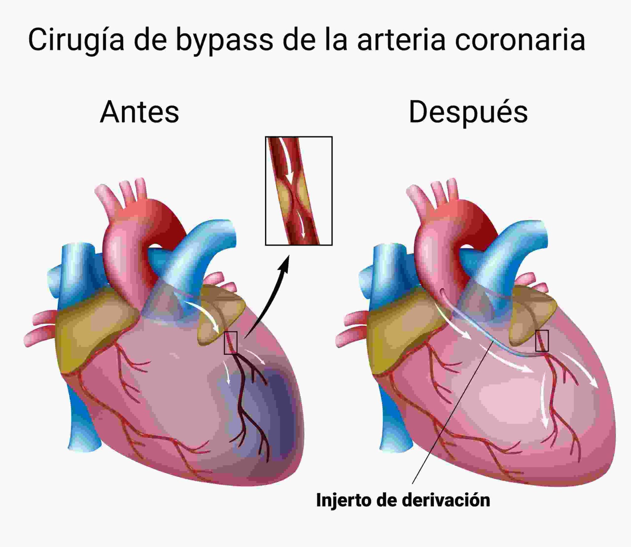 Cirugía de Bypass Coronario Dr. Carlos Brockmann Cirujano Cardiovascular en Bolivia