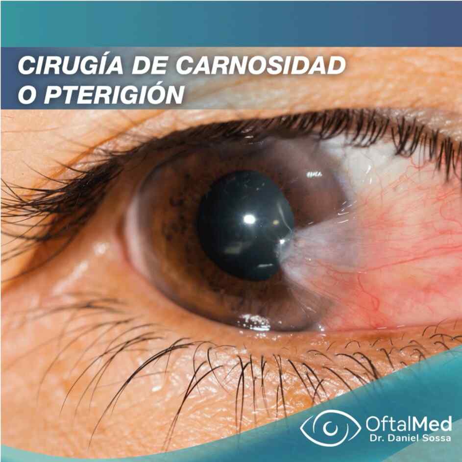 Cirugía de Carnosidad o Pterigión Dr. Daniel Sossa Mendez Cirujano Oftalmólogo Cochabamba