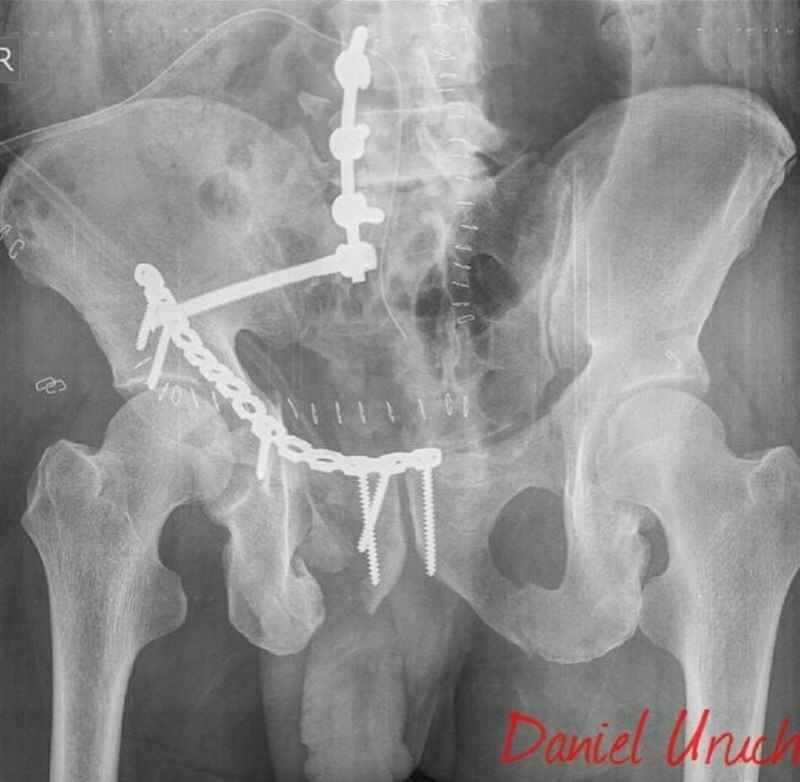Cirugía de Fijación Lumbopelvica Dr. Daniel Marcos Uruchi L. Traumatólogo Ortopedista La Paz