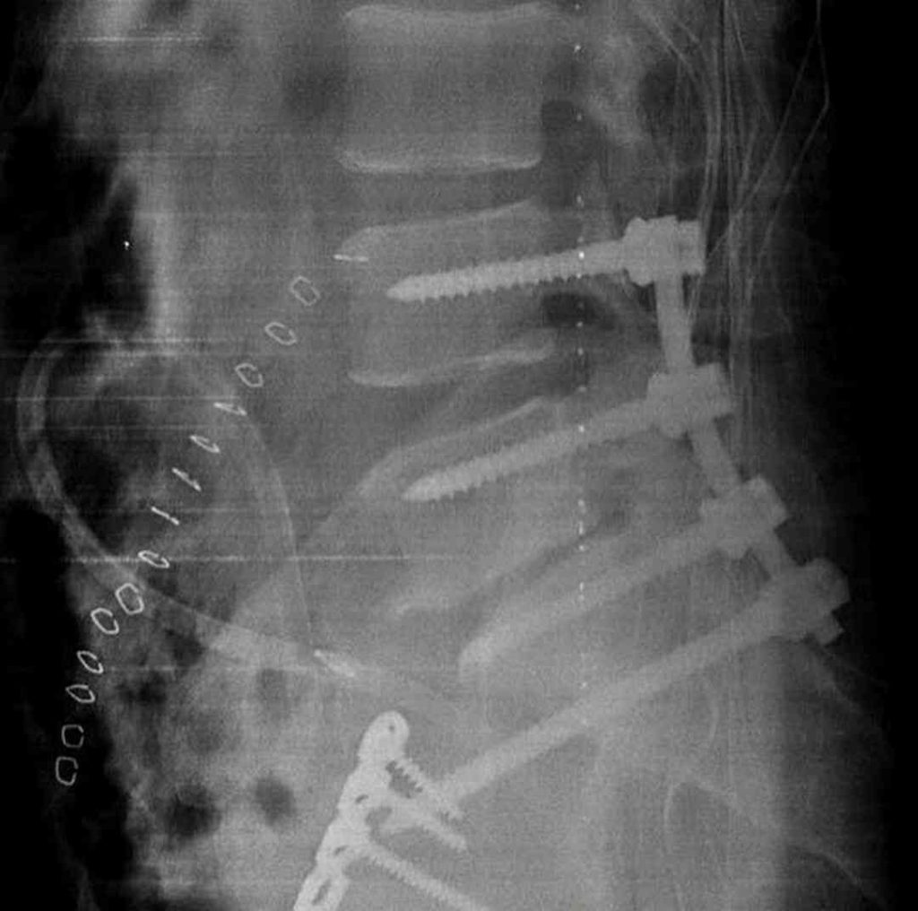 Cirugía de Fijación Lumbopelvica Dr. Daniel Marcos Uruchi L. Traumatólogo Ortopedista La Paz