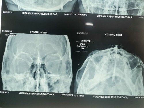Cirugía de Fractura Compleja de Arco Cigomático Centro de Cirugía Bucal y Traumatología Maxilofacial en Bolivia
