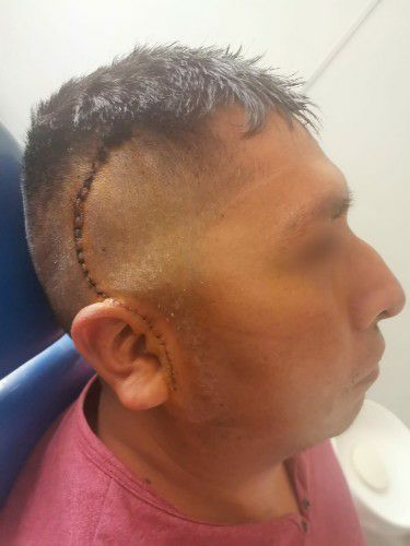 Cirugía de Fractura Compleja de Arco Cigomático Centro de Cirugía Bucal y Traumatología Maxilofacial en Bolivia