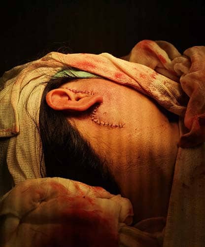 Cirugia de Glandula Parotida Centro de cirugía y traumatología bucomaxilofacial en Bolivia