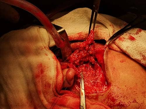 Cirugia de Glandula Parotida Centro de cirugía y traumatología bucomaxilofacial en Bolivia