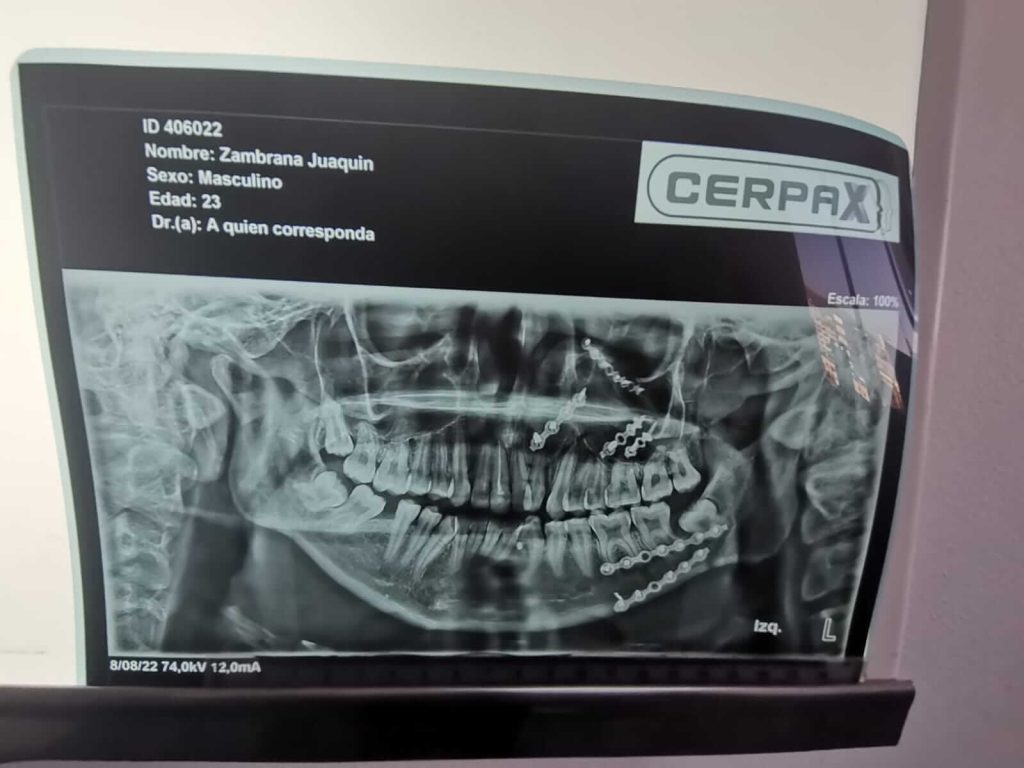 Cirujano Maxilofacial Cochabamba - Centro de Cirugía Bucal y Traumatología Maxilofacial en Bolivia
