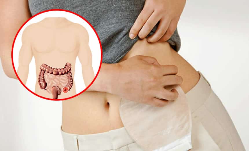 Colostomía Lic. Raisa Torrico Vilte Nutricionista Cochabamba