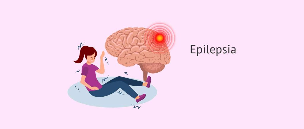 Convulsiones o Epilepsia Dra. Edna Catherine Serrano Arancibia Neuróloga La Paz