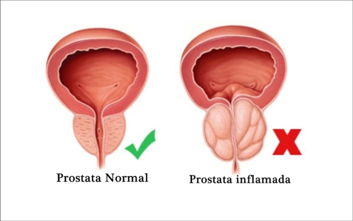 Crecimiento de la Próstata Dr. Rodrigo Orozco Cirujano Urólogo La Paz