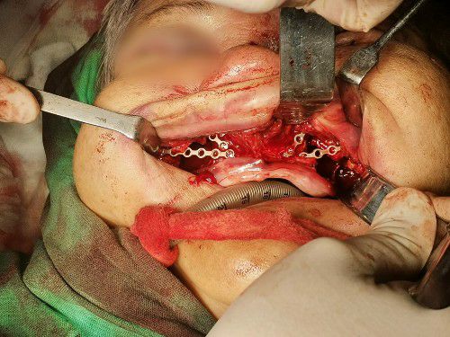 Desfiguración Facial Centro de Cirugía Bucal y Traumatología Maxilofacial en Bolivia