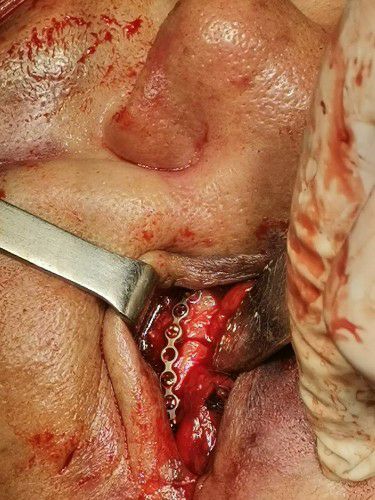 Desfiguración Facial Centro de Cirugía Bucal y Traumatología Maxilofacial en Bolivia