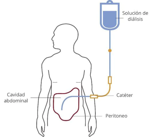 Dialisis - Dr. Israel Rivas Nefrologo Cochabamba 1