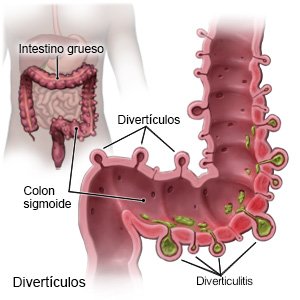 Diverticulosis y Dieta - Dr. Juan H. Valdivia Guiteras - Gastroenterólogo La Paz