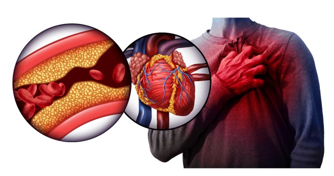 Dolor en el Pecho - Dr. Arturo Salazaar Vega Cardiologo Cochabamba 1