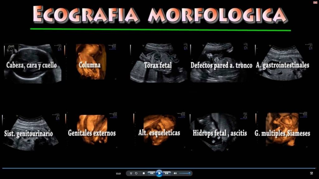Ecografía Morfológica Estructural Fetal 20 a 24 Semanas Rastreo Malformaciones Dr. Mirko A. Ferrufino Merino Ecografía Avanzada Cochabamba
