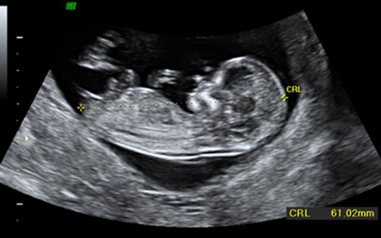 Ecografía Obstétrica 11 a 13 Semanas Screening de Cromosomopatías Dr. Mirko A. Ferrufino Merino Ecografía Avanzada Cochabamba