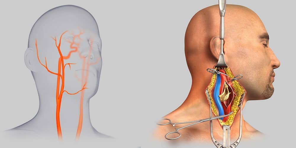 Endarterectomía Carotidea Dr. Benjo Gareca Villarpando Cirujano Cardiovascular Cochabamba
