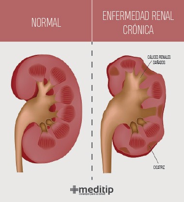 Enfermedad Renal Cronica - Dr. Israel Rivas Nefrologo Cochabamba 1