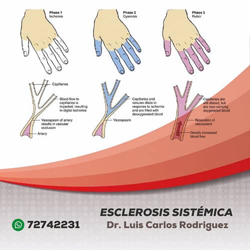 Esclerosis Sistemica - Dr. Luis Carlos Rodriguez Delgado – Reumatólogo en Cochabamba