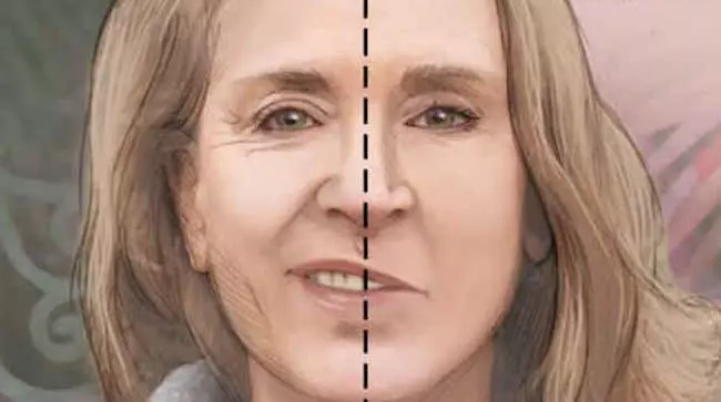 Espasmo Hemifacial Dr. Eduardo Lizarazu Gutierrez Neurocirujano Cochabamba