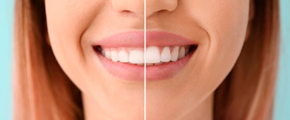Estética Dental Dra. Maythy Abasto Revollo Odontóloga Cochabamba