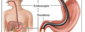 Estudio Endoscópico - Dr. Juan H. Valdivia - Gastroenterólogo - La Paz