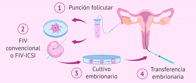 Fertilización In Vitro (icsi) Dr. Edwin D. Trujillo C. Ginecólogo Obstetra La Paz