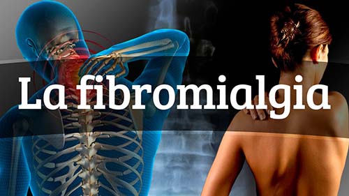 Fibromialgia Dr. Luis Carlos Rodriguez Delgado Reumatólogo Cochabamba