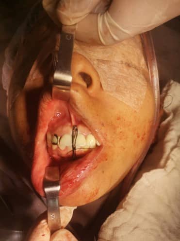 Fractura Baja de Cóndilo Mandibular Izquierdo Centro de Cirugía Bucal y Traumatología Maxilofacial en Bolivia