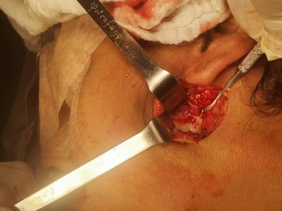 Fractura Baja de Cóndilo Mandibular Izquierdo Centro de Cirugía Bucal y Traumatología Maxilofacial en Bolivia