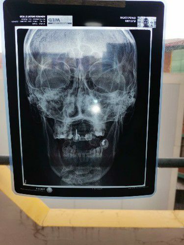 Fractura Facial Centro de Cirugía Bucal y Traumatología Maxilofacial en Bolivia