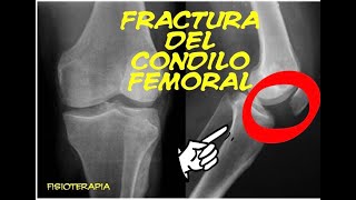 Fractura de Cóndilo Femoral Dr. Arnold Vergara Montán Traumatólogo Cochabamba