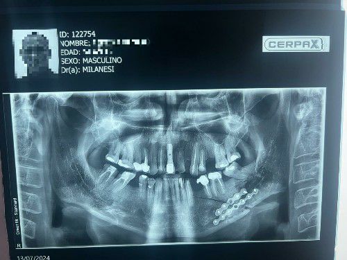 Fractura de Mandíbula Centro de Cirugía y Traumatología Bucomaxilofacial Bolivia