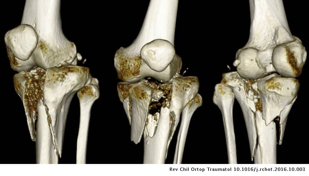 Fractura de la Meseta Tibial Dr. Arnold Vergara Montán Traumatólogo Cochabamba