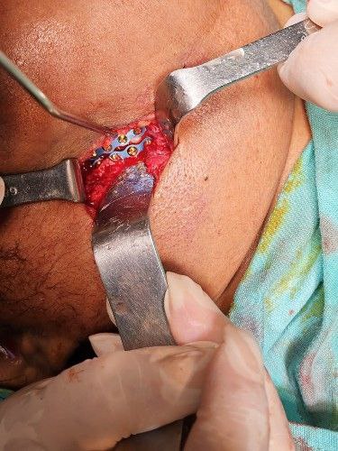 Fracturas Bajas y Desplazadas del Cóndilo Mandibular Centro de Cirugía Bucal y Traumatología Maxilofacial en Bolivia