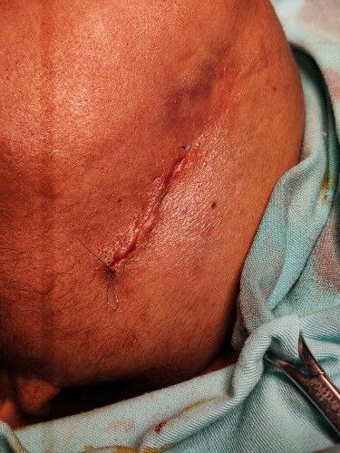 Fracturas Bajas y Desplazadas del Cóndilo Mandibular Centro de Cirugía Bucal y Traumatología Maxilofacial en Bolivia
