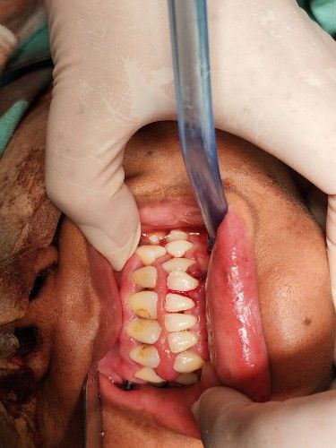 Fracturas Bajas y Desplazadas del Cóndilo Mandibular Centro de Cirugía Bucal y Traumatología Maxilofacial en Bolivia