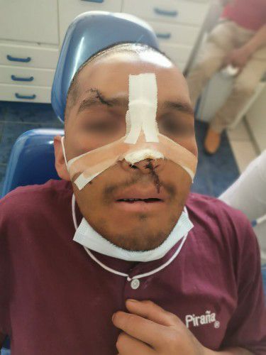 Fracturas Faciales Centro de Cirugía Bucal y Traumatología Maxilofacial en Bolivia