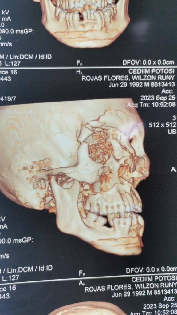 Fracturas Faciales Centro de Cirugía Bucal y Traumatología Maxilofacial en Bolivia