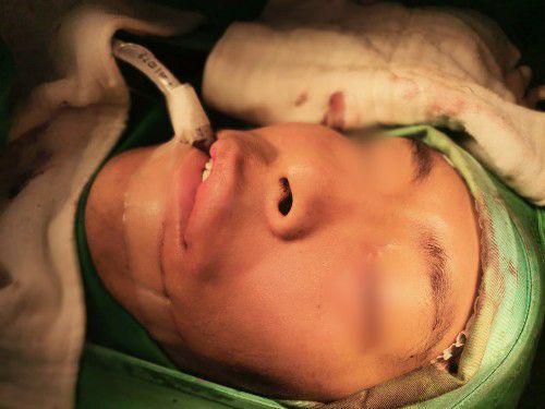 Fracturas Faciales con Secuelas Cirugia Maxilofacial - Centro de Cirugía Bucal y Traumatología Maxilofacial en Bolivia