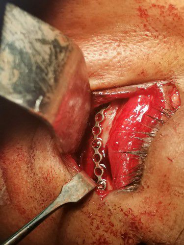 Fracturas Faciales de Orbita y Cigomático Centro de Cirugía Bucal y Traumatología Maxilofacial en Bolivia