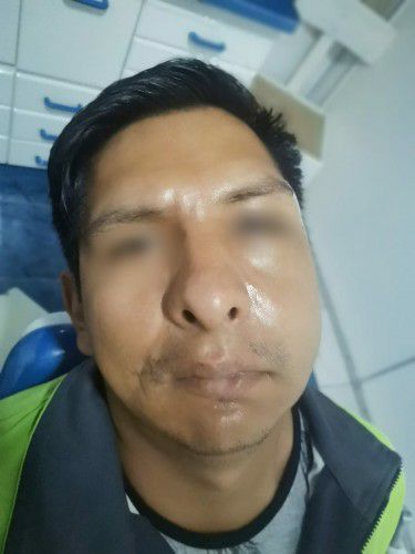 Fracturas Faciales de Orbita y Cigomático Centro de Cirugía Bucal y Traumatología Maxilofacial en Bolivia