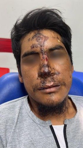 Fracturas de la Nariz Centro de Cirugía Bucal y Traumatología Maxilofacial en Bolivia