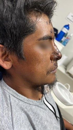 Fracturas de la Nariz Centro de Cirugía Bucal y Traumatología Maxilofacial en Bolivia