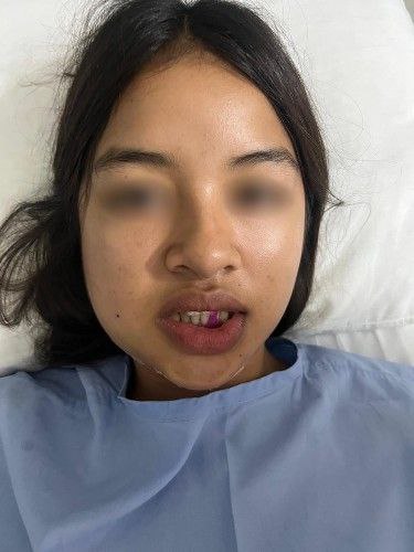 Fracturas del Cóndilo Mandibular Centro de Cirugía Bucal y Traumatología Maxilofacial en Bolivia