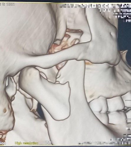 Fracturas del Cóndilo Mandibular Centro de Cirugía Bucal y Traumatología Maxilofacial en Bolivia