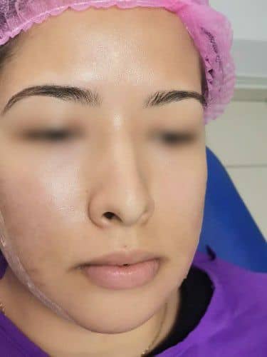 Genioplastia o Mentoplastia Estética Centro de Cirugía Bucal y Traumatología Maxilofacial en Bolivia