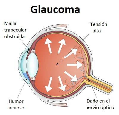 Glaucoma Dra. Paola Zurita Ferrel Oftalmóloga Cochabamba